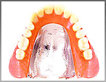 コバルトクローム床義歯製作例