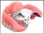 チタン床義歯製作例