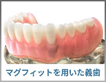 磁性アタッチメント義歯(マグネットデンチャー、マグフィット)